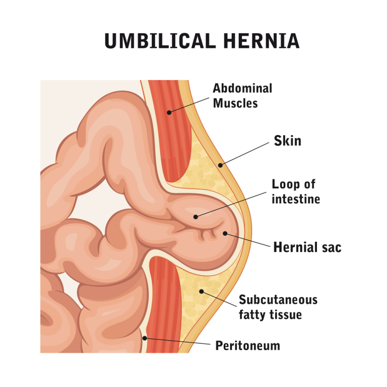 Umbilical Hernia Surgery near Detroit MI